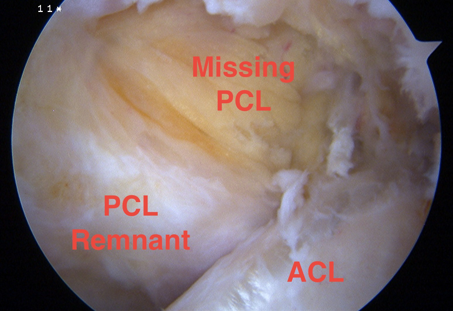 PCL Tear Arthroscopy